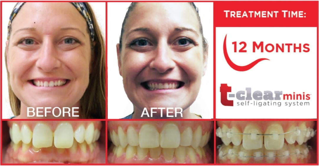 Why Choose TenBrook Orthodontics